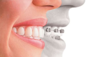 Existe tempo de adaptação ao aparelho odontológico?